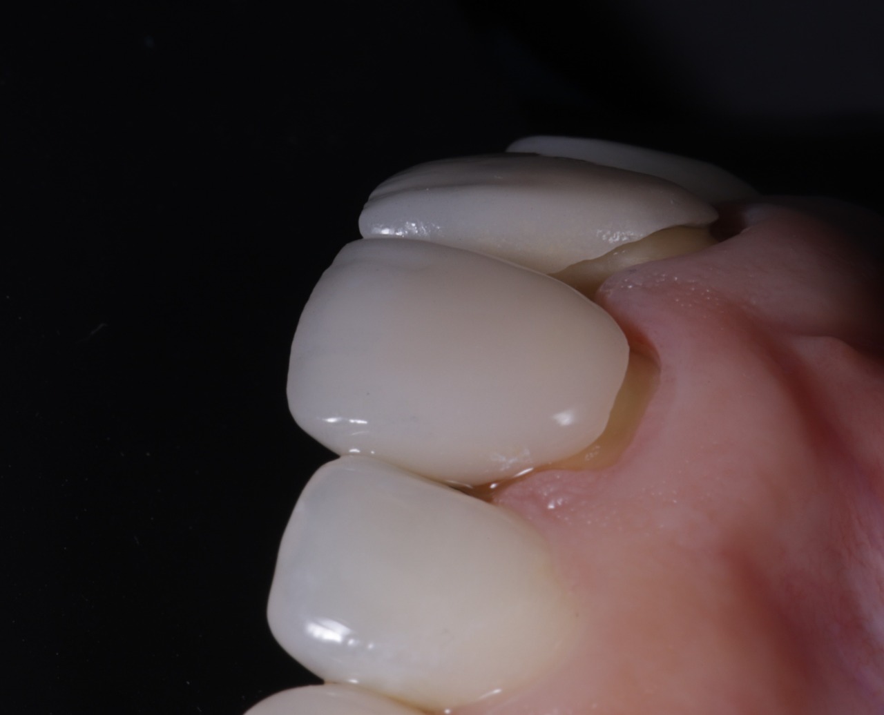 Carillas de Porcelana