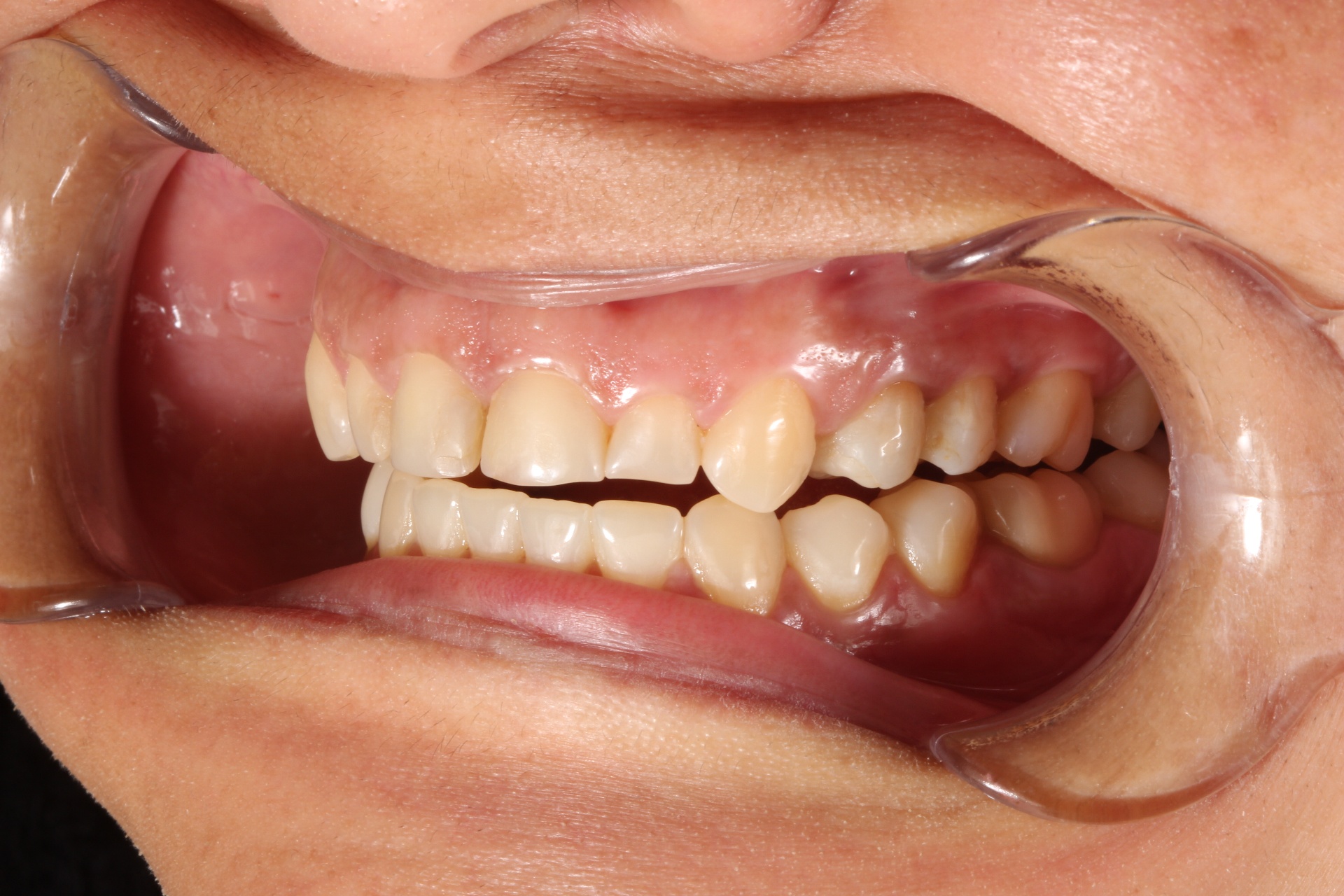 Diseño de sonrisa integral — antes