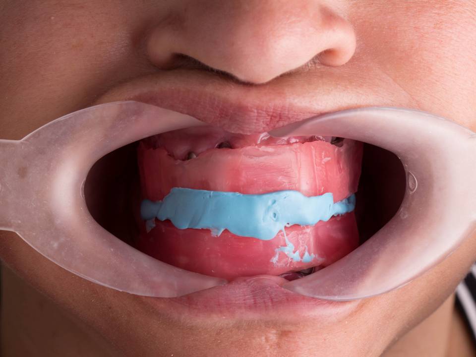 Rehabilitación oral completa — antes